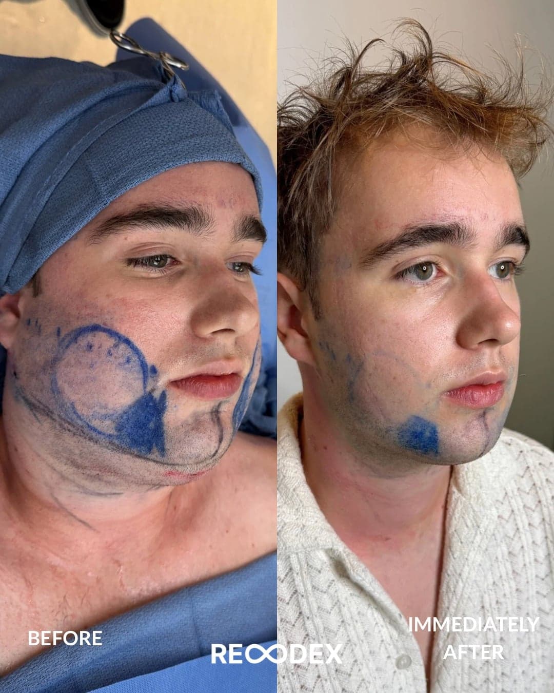 Male Facial Sculpting Before and After