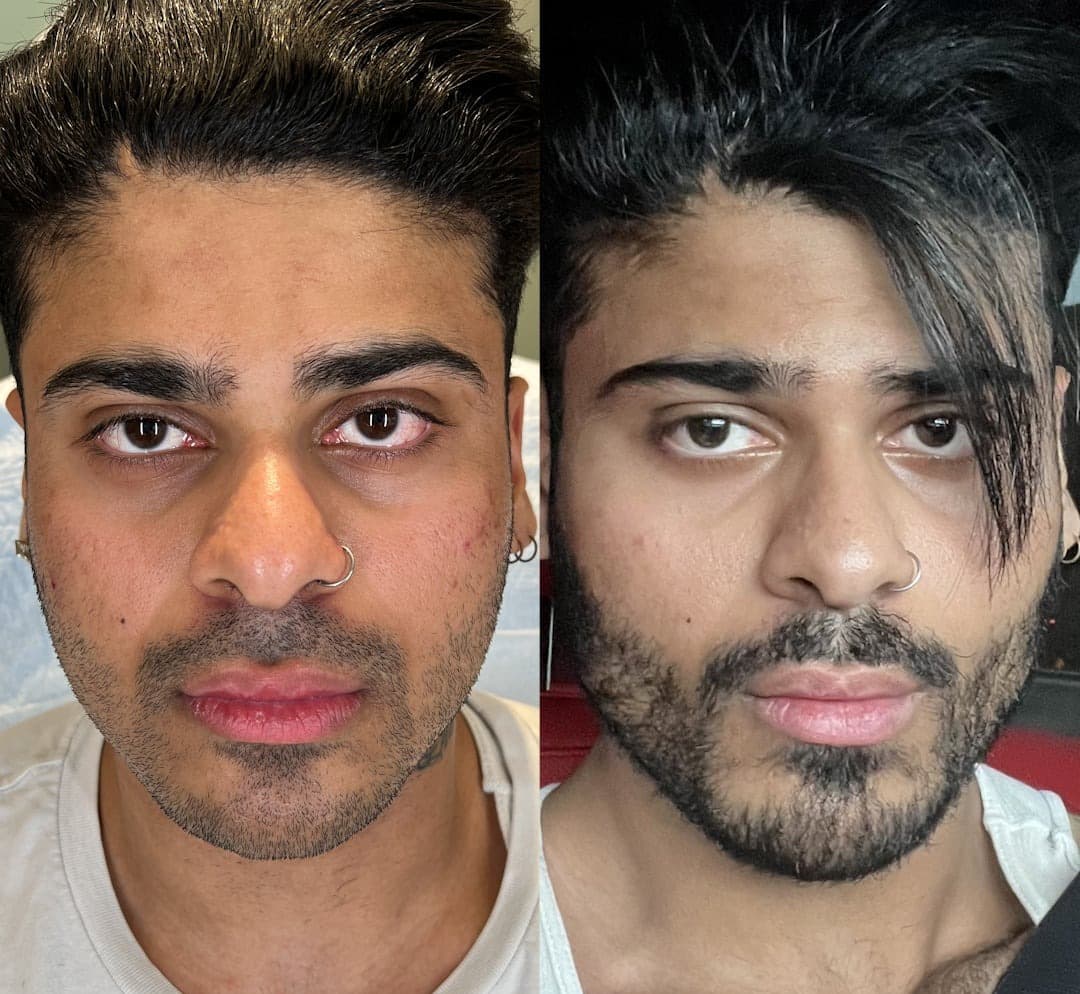 Male Facial Sculpting Before and After
